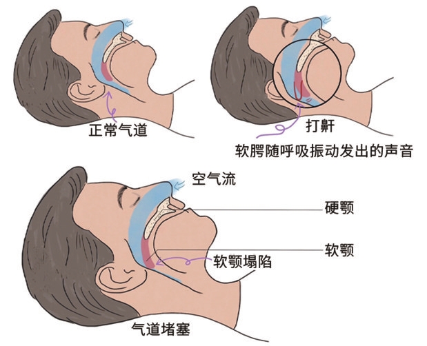 “止鼾神器”真的有效吗
